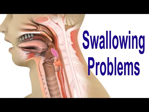 Swallowing Problems or Dysphagia: Top 4 Possible Causes Including Cricopharyngeal Dysfunction (CPD)
