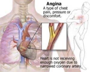 Angina diagram