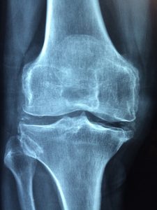 Knee x-ray